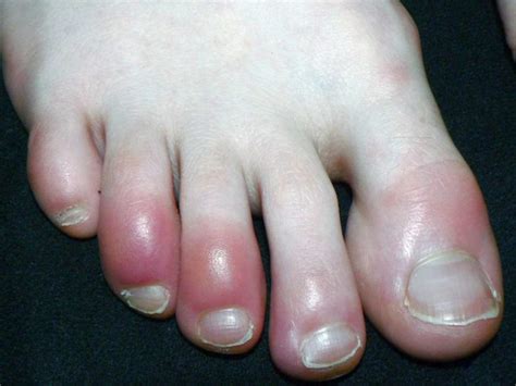 Toes Swollen And Itchy Oultet Website Save 67 Jlcatjgobmx
