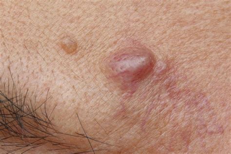 How To Spot And Treat Epidermoid Cysts Hot Sex Picture