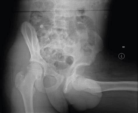 Traumatic Anterior Hip Dislocation In An Adolescent With An Associated