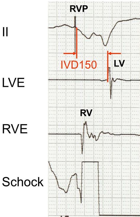 Right Ventricular Pacing With Interventricular Delay Of 150ms Surface