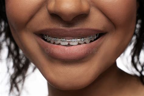 Closeup Of Black Woman S Smile With A Dental Braces On Teeth Stock Image Image Of African