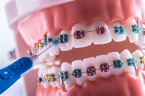 Ortodoncia Una Solución Para Una Sonrisa Saludable Y Alineada Top
