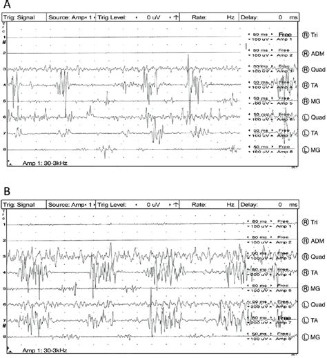 Mixed Orthostatic Myoclonus And Slow Orthostatic Tremor A While The Download Scientific