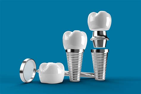 Partes De Los Implantes Dentales Clínica En Trujillo