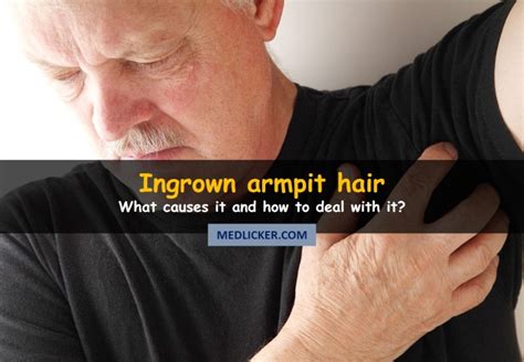 How To Fix Ingrown Hair In Armpit Persistent Ingrown Hairs When