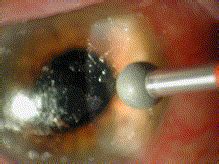 1 division of cornea, external disease and refractive surgery, w. Techniques, indications and complications of corneal ...