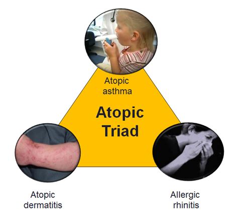 Atopic Triad Asthma Asthma Symptoms Dermatitis