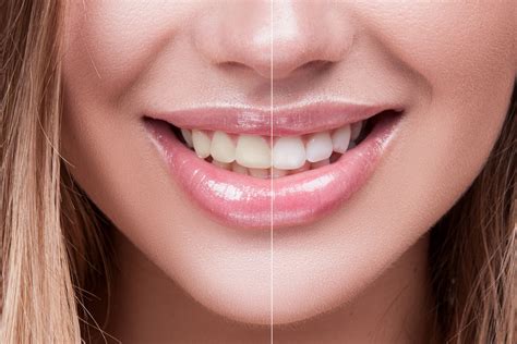 How Do I Know If I Need Teeth Whitening Goleta Ca Aloe Dental Wellness