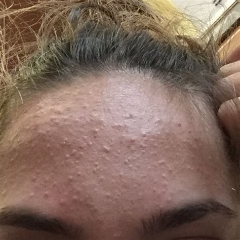 Hundreds Of Forehead Bumps I Can T Get Rue Of General Acne Discussion Acne Org Forum