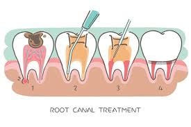 Some signs aren't too obvious and only show up. How to know you need a root canal? - #1 Dental Office in ...