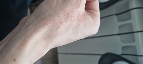 Сыпь на руке как лечить Вопрос аллергологу 03 Онлайн