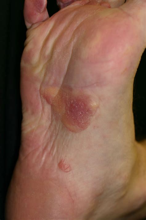 Systemic Amyloidosis With Cutaneous Manifestations Amyloidosis