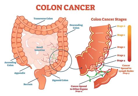 Colon Cancer Stages Symptoms Causes And Screening
