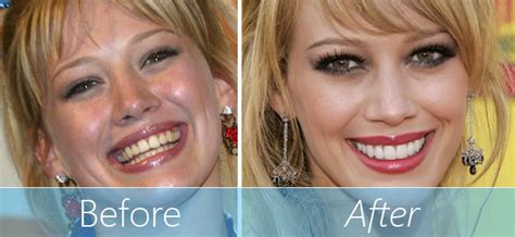 Celebrity Teeth Veneers Before After