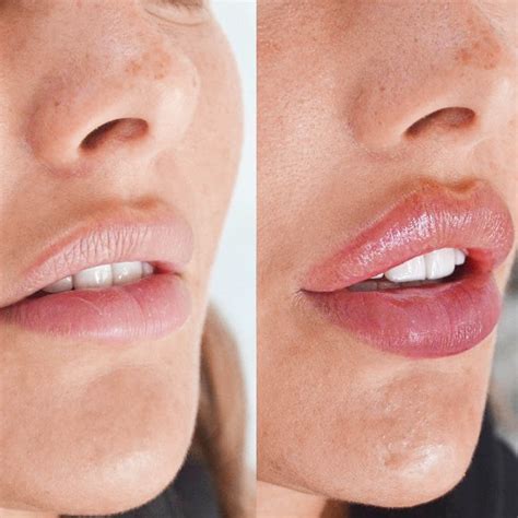 Russian Lip Filler Before After Skinly Aesthetics