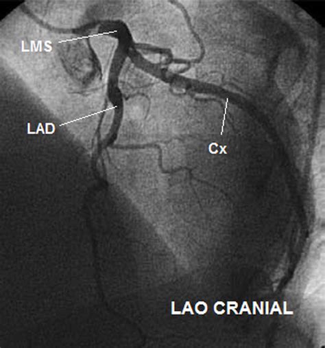 Normal Angiography