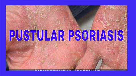 Pustular Psoriasis Treatment