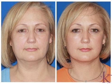 Facelift Dr Vasyukevich Facial Plastic Surgeon Nyc 52