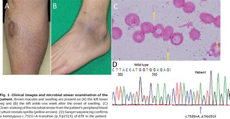 Figure 1 From Recurrent Cellulitis Caused By Helicobacter Cinaedi In A