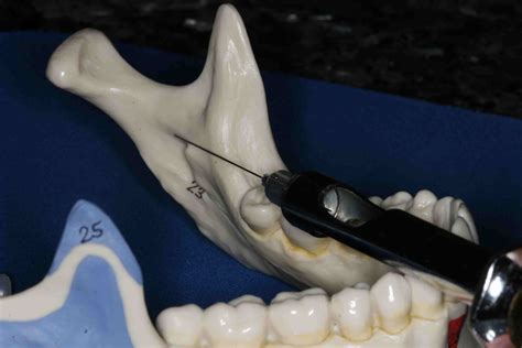 Dental Anesthesia Mandibular Block For Pediatric Pati
