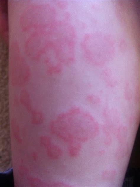 Baby Borneo Or Bust And Now Fun With Amoxicillin Allergy