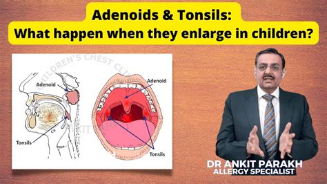 Adenoids And Tonsils What Happen When They Enlarge In Children I Dr