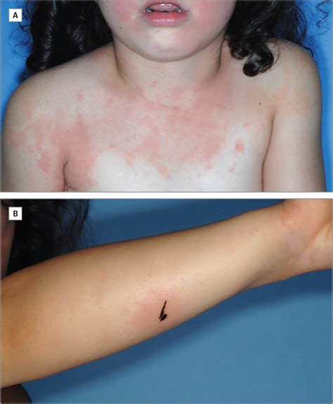 A Widespread Pruritic Rash With Facial Swelling And Black Streaks