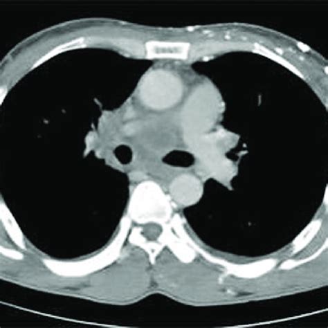 Axial Contrast Enhanced Computed Tomography Image Demonstrating A Download Scientific Diagram