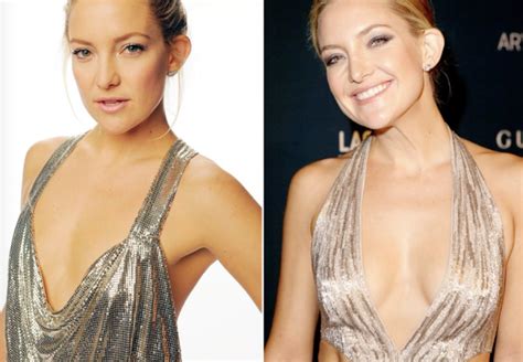 Breast Augmentation Before And After Celebrity Edition Atlantic