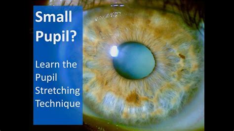 Small Pupil Try Pupil Stretching For Successful Cataract Surgery Youtube