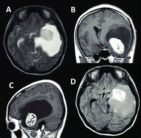 Mri Brain Depicting A Solid Cystic Tumor At The Left Temporo Parietal