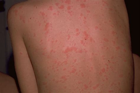Viral Exanthem Pictures Treatment Symptoms Causes January