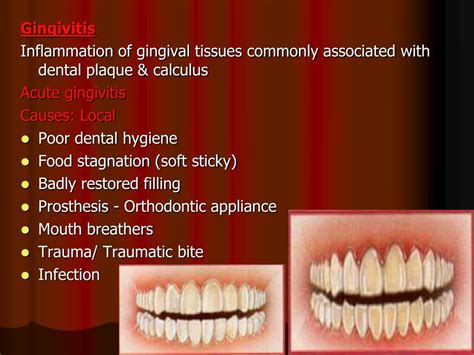 PPT Gingivitis Inflammation Of Gingival Tissues Commonly Associated