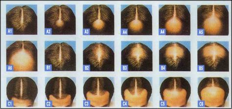 What is the hair growth cycle? Causes Of Male Baldness