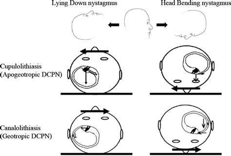 Mechanism Of Nystagmus Induced By Position Change In The Pitch Plane In