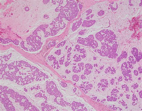 Cureus A Case Of Eccrine Mucinous Carcinoma Involving Scalp