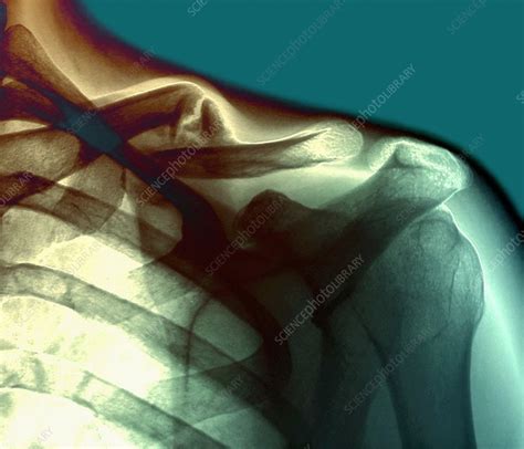 Broken Collar Bone X Ray Stock Image M3301017 Science Photo Library
