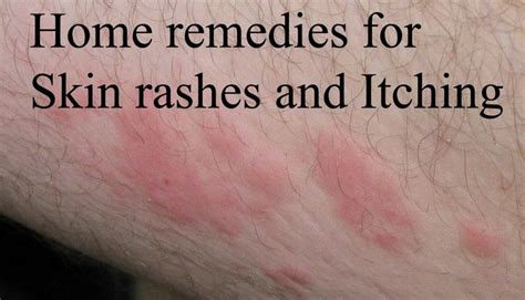 Best Home Remedies For Skin Rashes And Itching Online Bee Home Remedies For Rashes Home