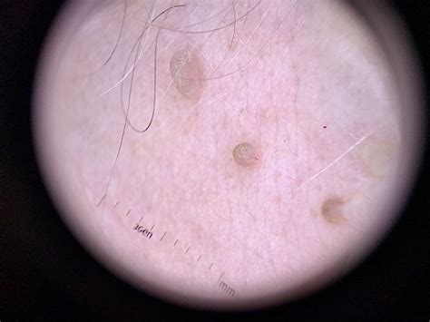 Pathology Outlines Cutaneous Fibroepithelial Polyps