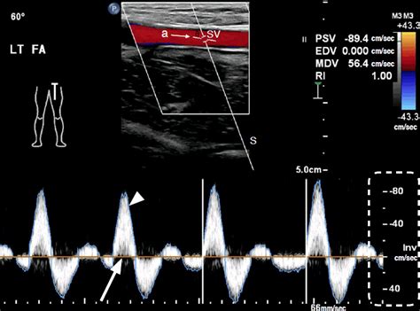Color And Pulsed Wave Doppler Sonograms Of Normal Lower Extremity