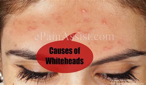 What Causes Whiteheads And How To Get Rid Of Them