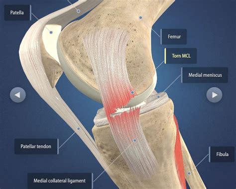 The Dos And Donts After Acl And Mcl Tears And Surgery Heiden Orthopedics