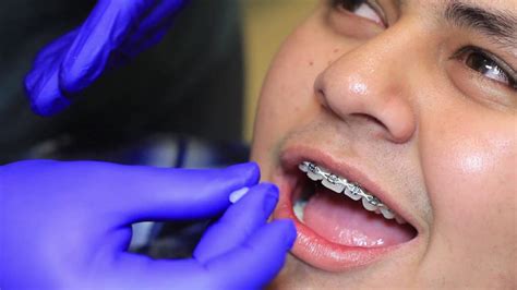 The first few days after your orthodontist puts them in, they this dental wax for braces is easy to apply, goes on clear and has a refreshing mint flavor. How to Use Wax - Braces & Invisalign in OKC - Sky Ortho ...