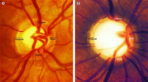 Ophthalmoscopic Photographs Of Healthy And Glaucomatous Optic Discs