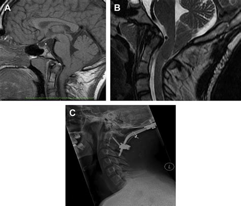 Craniovertebral Junction Instability In The Setting Of Chiari I