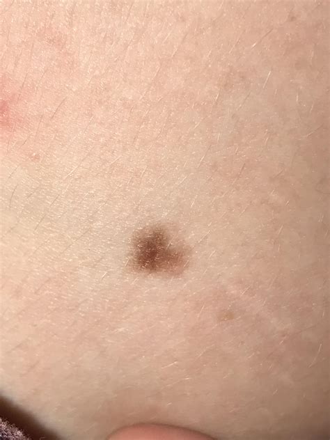 Normal Or Should I Get It Checked Melanoma