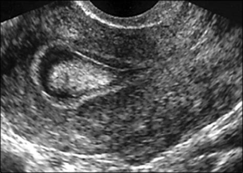 Transvaginal Ultrasound Showing A Thick Endometrial Cavity With