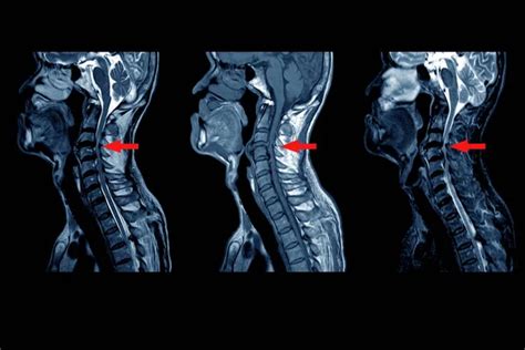 Cervical Fracture Human Spine Vertebrae Damage Outline Diagram Labeled