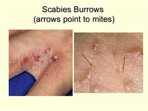Scabies Bites On Humans Pictures Photos