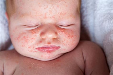 Little Red Spots On Baby Face And Neck Baby Tickers